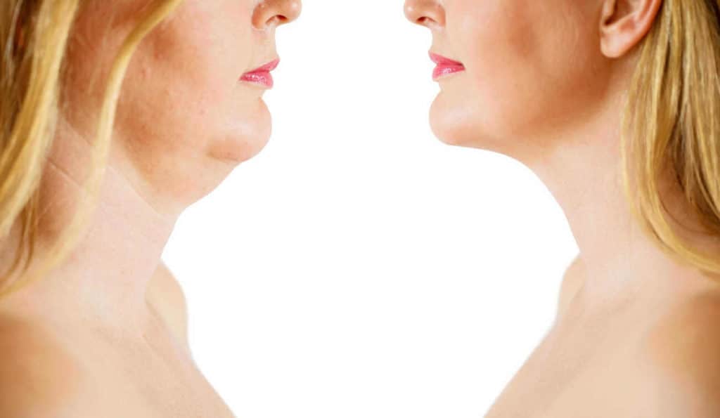 Double Chin treatment Hedge End before and after results