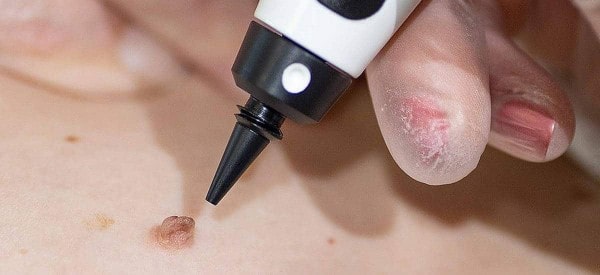 After Skin Tag Removal Hedge End