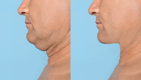 Which Non-Surgical Treatments Work Best for Jowls and Loose Skin Hedge End?