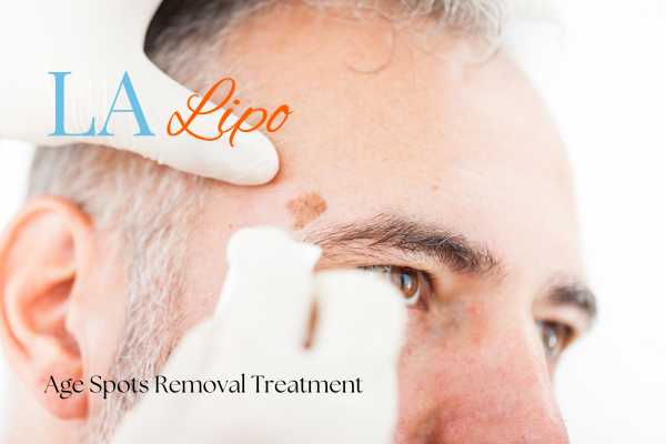 What Are the Most Effective Treatments for Age Spots Hedge End?