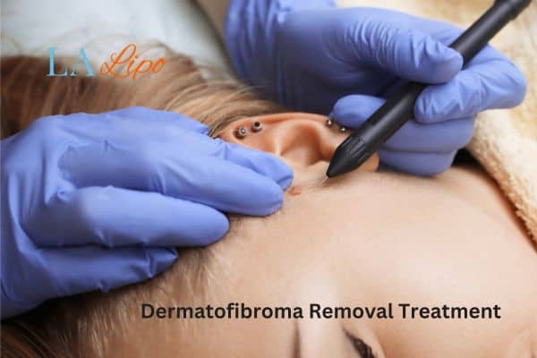 Dermatofibroma Removal Treatment Hedge End