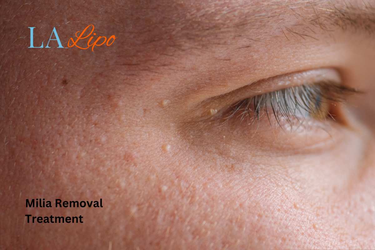 Cryopen Milia Removal: Is It the Easiest and Safest Option Hedge End?