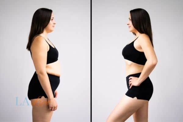 image of woman before and after results of LA-EMS Body Sculpting Hedge End to help treat Diastasis recti