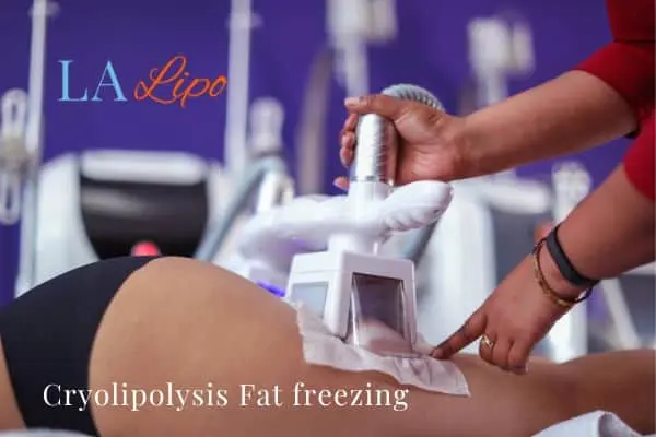 women getting fat freezing Hedge End