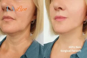 hi-fu for wrinkles Hedge End before and after results