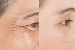 Before and after results of woman - HI-fu wrinkles reduction treatment Hedge End