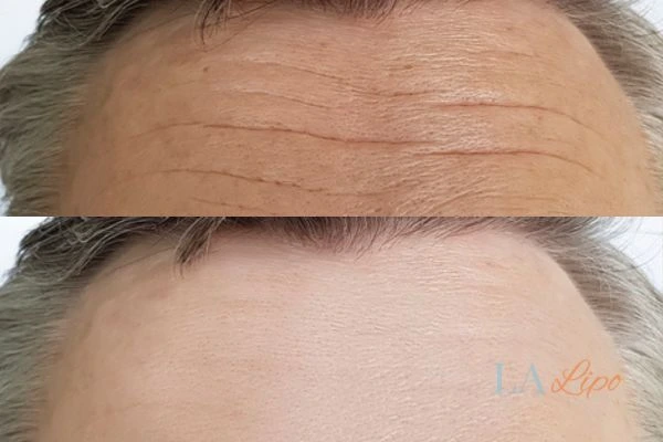 results of HIFU Hedge End on mans forehead to help reduce lines and wrinkles