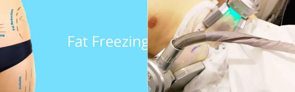 Fat freezing Hedge End on multiple areas of the body