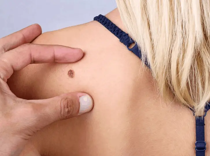 woman having mole removal Hedge End consultation before treatment.