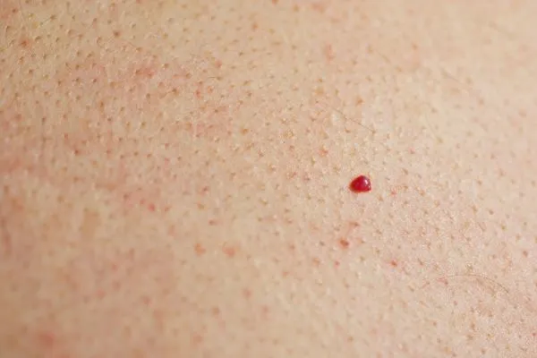 close up of a cherry angioma Hedge End