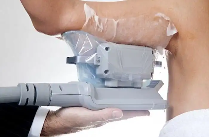 Picture of fat freezing Hedge End on the upper arms.