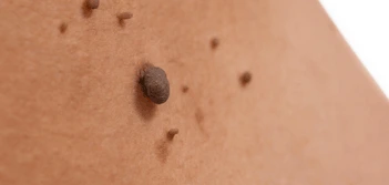 image of a skin tag Hedge End