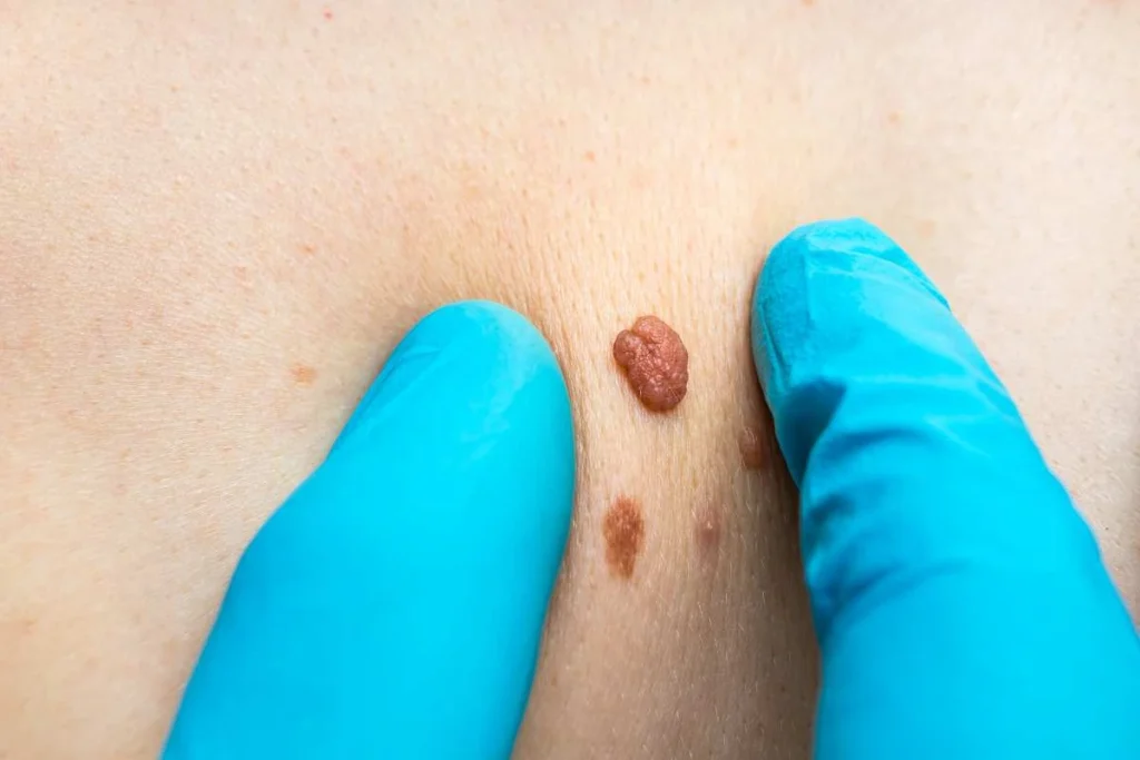 Consultant examining a skin tag Hedge End
