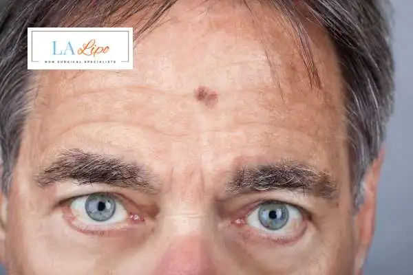 Solar Lentigo Removal Hedge End image of man with mark on his forehead