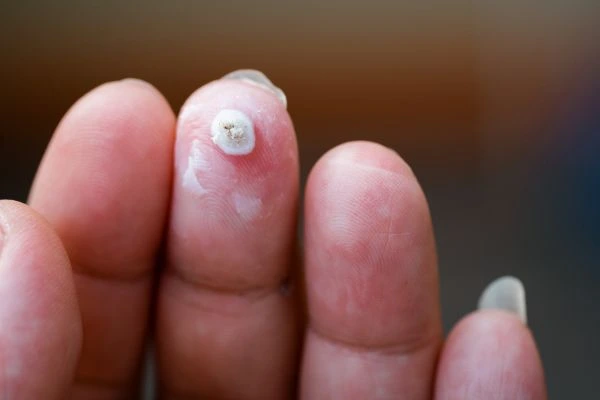 wart on person finger - cryotherapy to treat from LA LIPO Hedge End