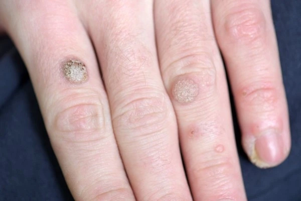 photo of warts on person hand - see wart removal Hedge End from LA LIPO