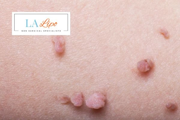 Does cryopen skin tag removal Hedge End hurt? Find out now call our team today!