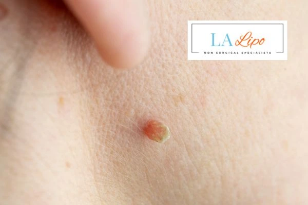 Book skin tag removal Hedge End today speak to our team now!