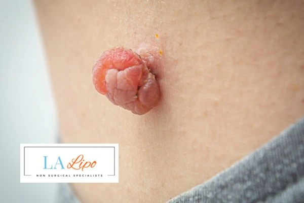 Interested in skin tag removal Hedge End? Concerned about the pain? Find out more today!