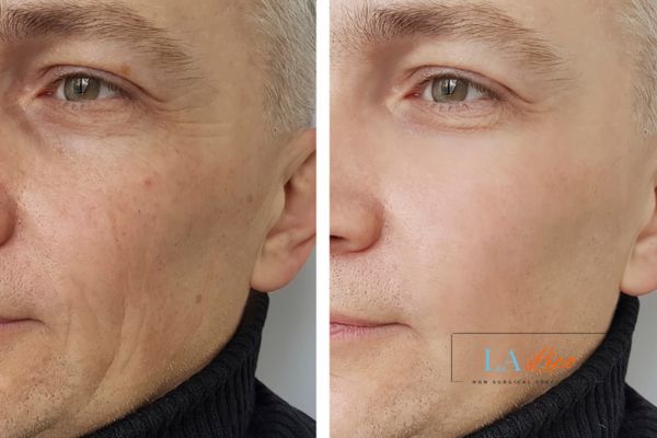 See the amazing results of Morpheus8 Treatment Hedge End!