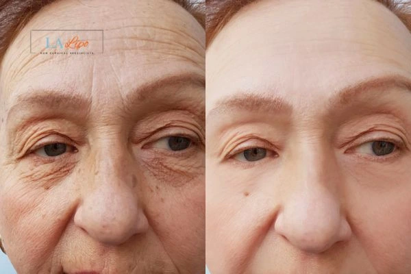 The powerful benefits of Morpheus8 Treatment Hedge End - Call Our team today!