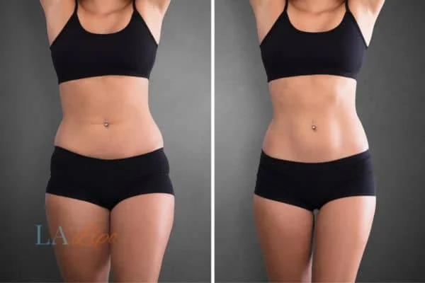 before and after results of non-surgical treatment to help a woman's body image and mental health Hedge End