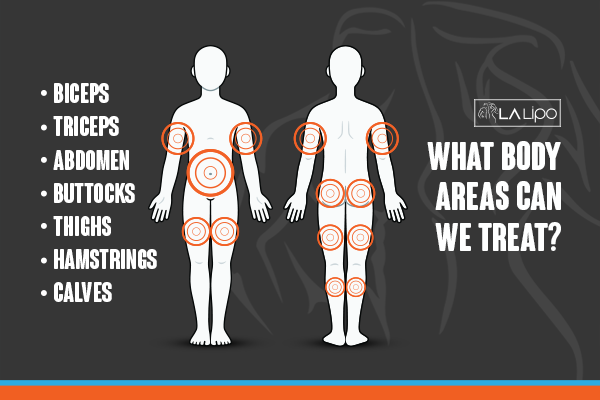 Diagram to show areas you can have LA-EMS Body Sculpting Treatment Hedge End