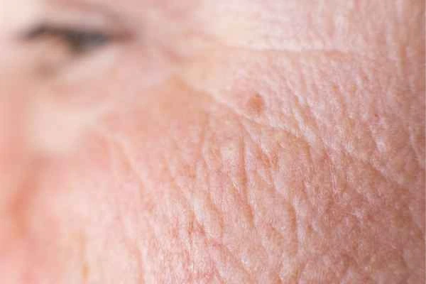 close up picture of a woman's face showing an age spot Hedge End