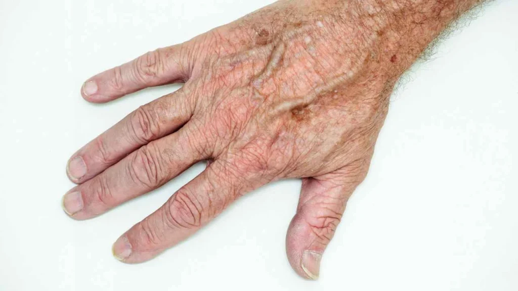 Male hand showing age spot Hedge End