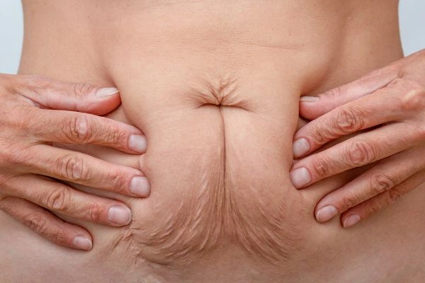 Image of a woman's stomach with loose skin - example of skin tightening Hedge End options