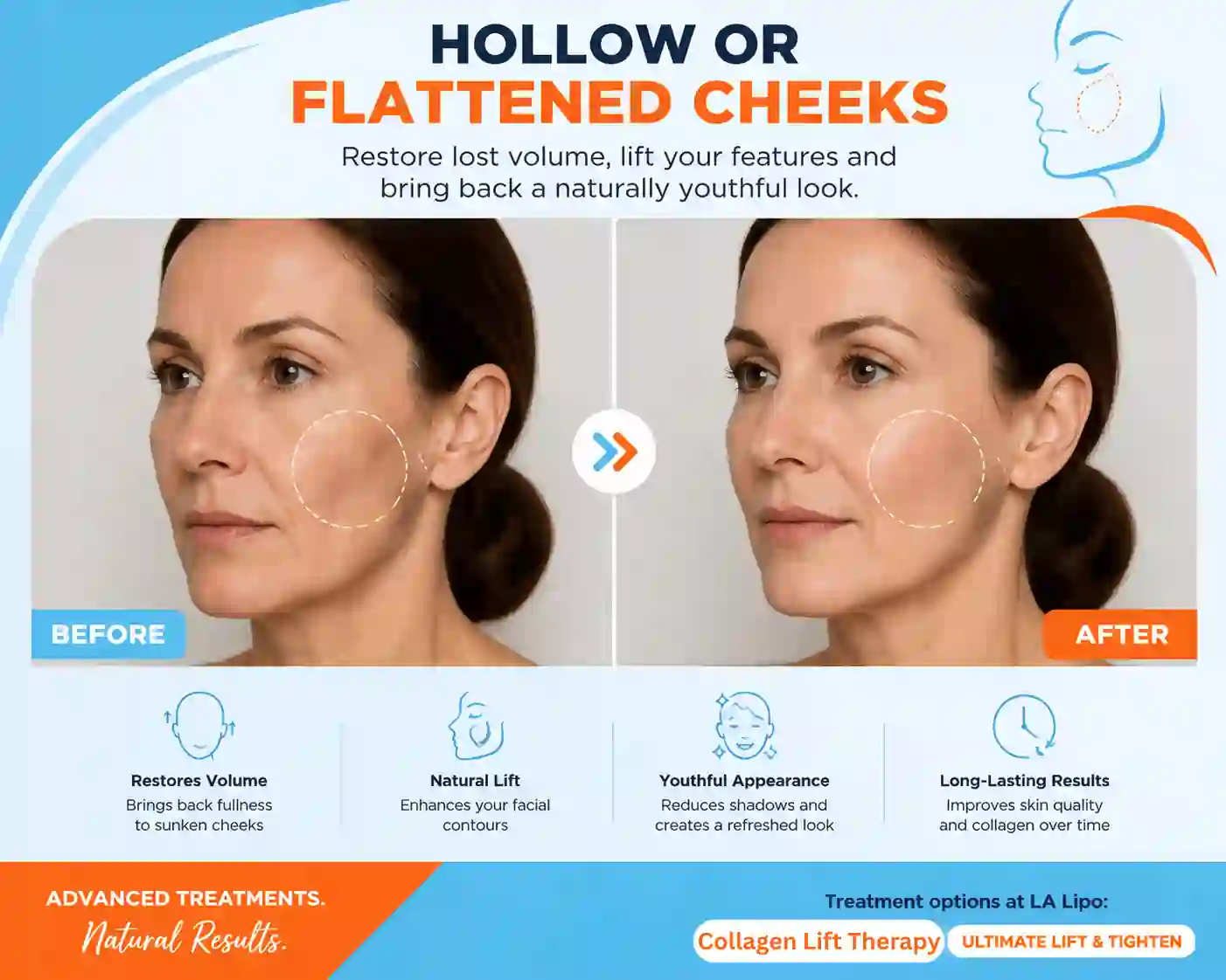 Sign #4: Hollow or Flattened Cheeks Hedge End